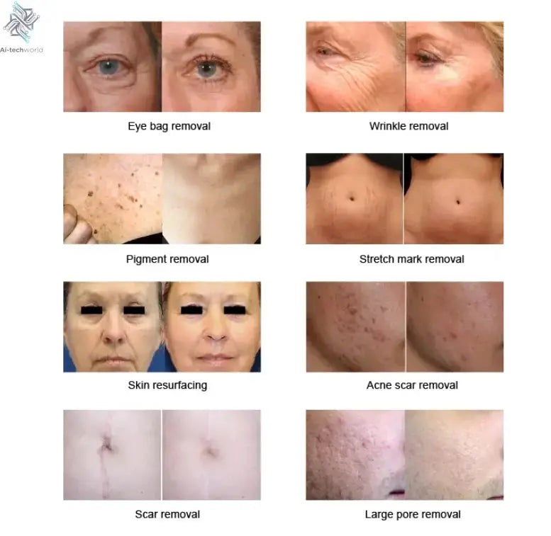 Fractional 4D CO2 Lase Scar Removal Machine 4D Fotona Co2 Fractional lase Machine Skin tightening Wrinkle Remover Ai-TechWorld 