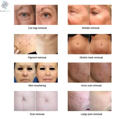 Fractional 4D CO2 Lase Scar Removal Machine 4D Fotona Co2 Fractional lase Machine Skin tightening Wrinkle Remover Ai-TechWorld 