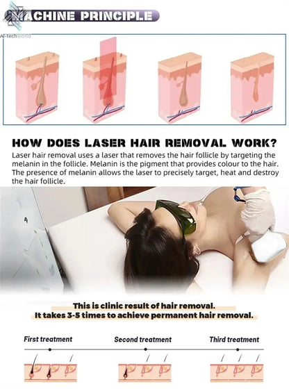 Professional Ice Titanium 808nm Diode Laser Hair Removal Machine with Triple Wavelengths for Painless Permanent Depilation Ai-TechWorld 