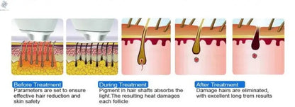 Professional Ice Titanium 808nm Diode Laser Hair Removal Machine with Triple Wavelengths for Painless Permanent Depilation Ai-TechWorld 