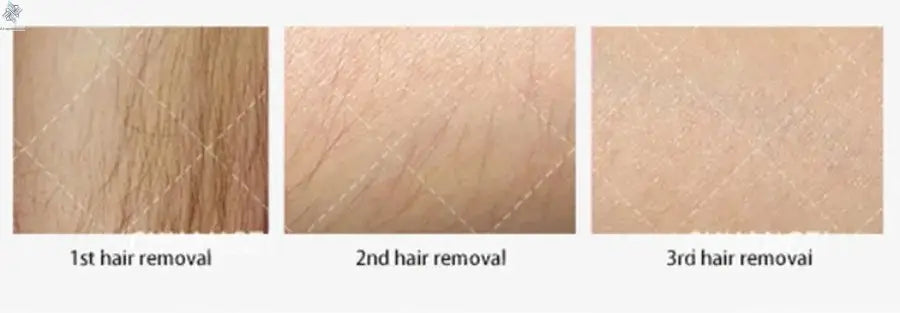 Professional Ice Titanium 808nm Diode Laser Hair Removal Machine with Triple Wavelengths for Painless Permanent Depilation Ai-TechWorld 
