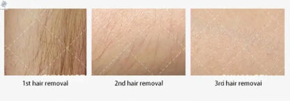 Professional Ice Titanium 808nm Diode Laser Hair Removal Machine with Triple Wavelengths for Painless Permanent Depilation Ai-TechWorld 