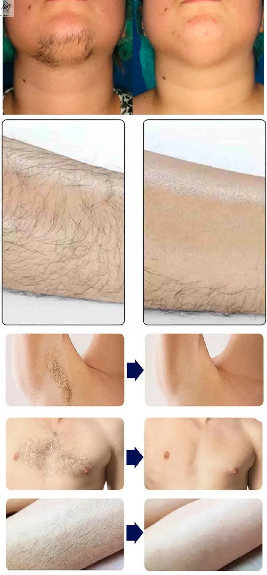 Professional Ice Titanium 808nm Diode Laser Hair Removal Machine with Triple Wavelengths for Painless Permanent Depilation Ai-TechWorld 