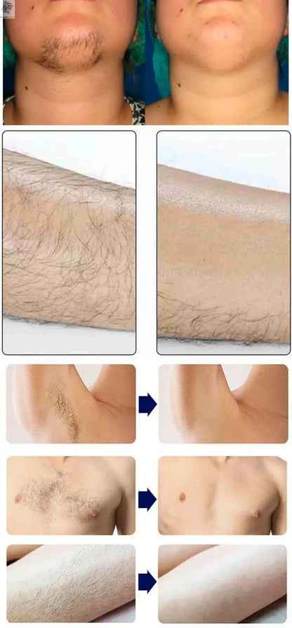 Professional Ice Titanium 808nm Diode Laser Hair Removal Machine with Triple Wavelengths for Painless Permanent Depilation Ai-TechWorld 