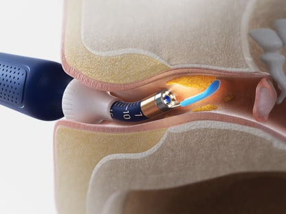 2025 New Bebird Earsight Plus I35R Ear Wax Removal Tool Camera Cleaner Kit- HD Wireless Flexible Otoscope, Pain-Free Ear Tweezer Ai-TechWorld 