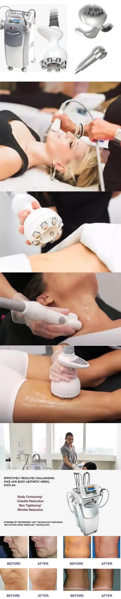 Venus Legacy Body Treatment 3 in 1 Venus Legacy Cabezal De Radiofrecuencia Corporal - Ai - TechWorld